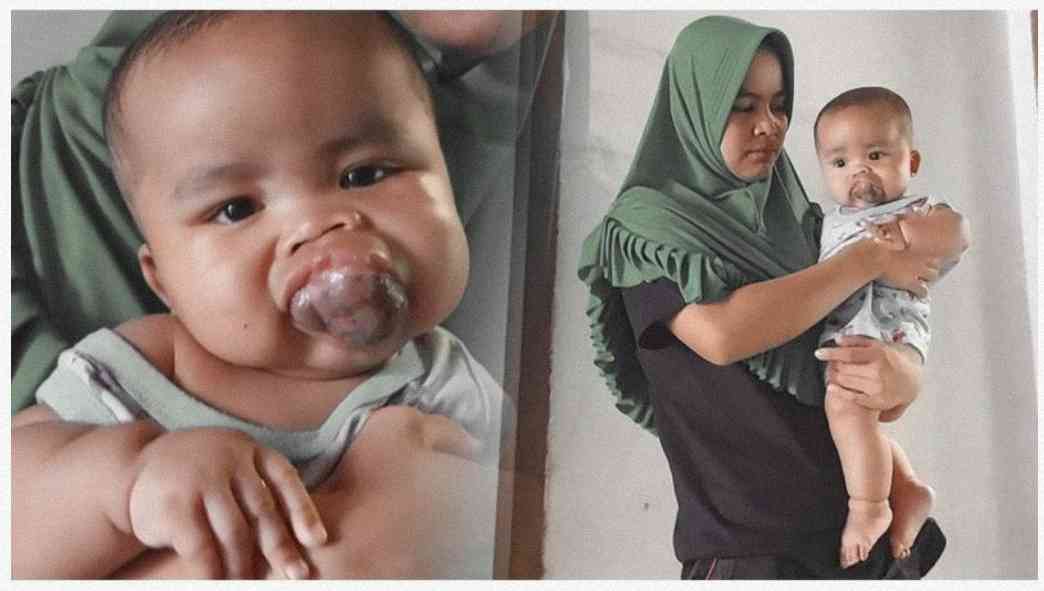 Baru Berumur 5 Bulan, Adik Ini Menderita Tumor Di Mulutnya